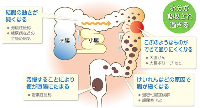 宿便の便秘症状はどのように改善されますか? _ 宿便って本当にあるのか – FQFHTV