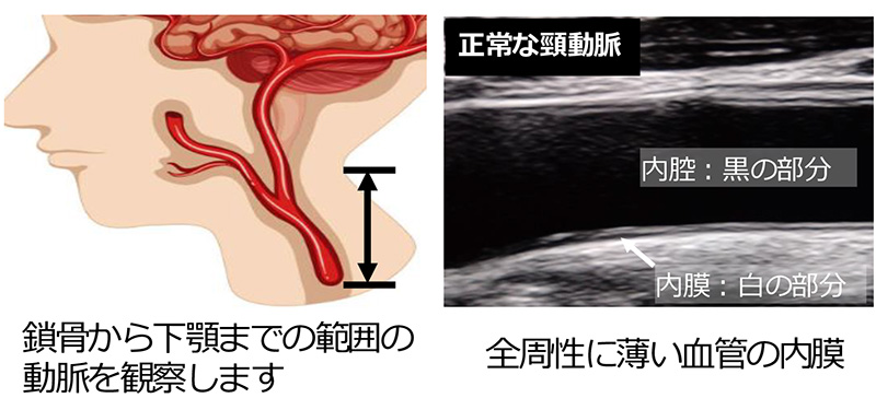 正常な頸動脈の模式図とエコー画像
