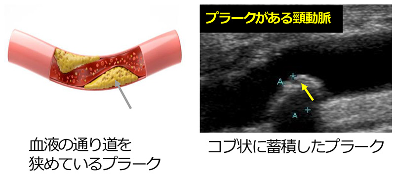 プラークのある頸動脈の模式図とエコー画像