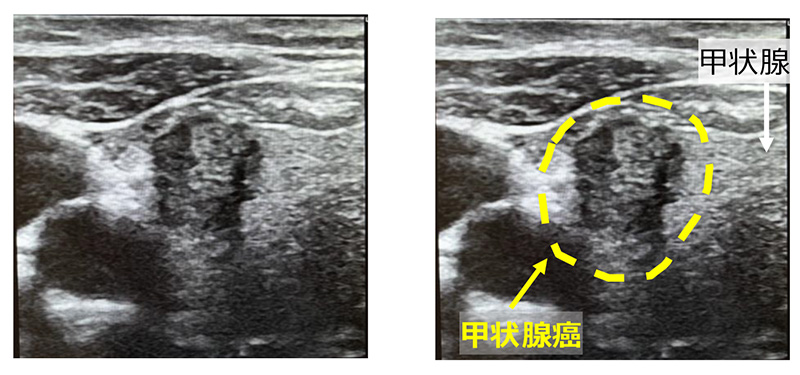 甲状腺癌のエコー画像