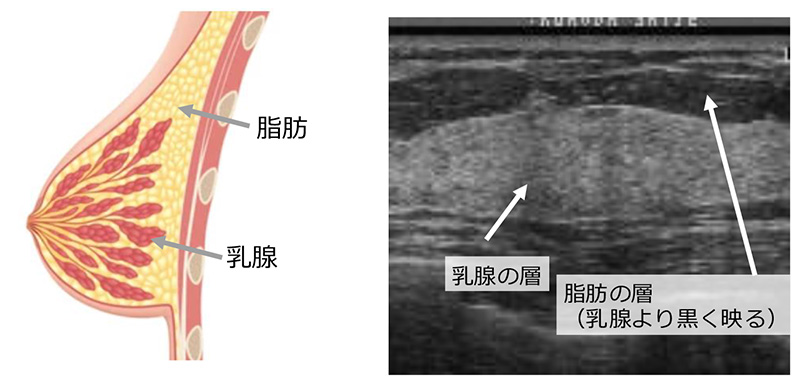 正常な乳腺の構造とエコー画像