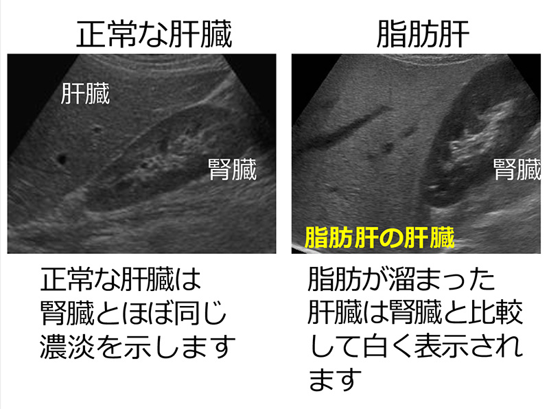 脂肪肝の評価
