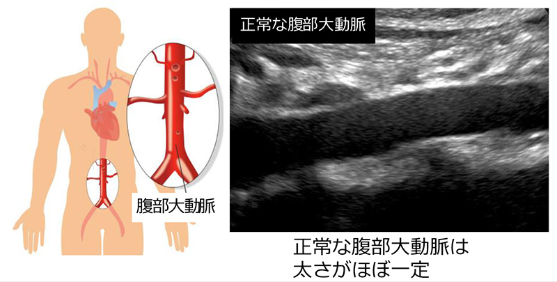 正常な腹部大動脈のエコー画像