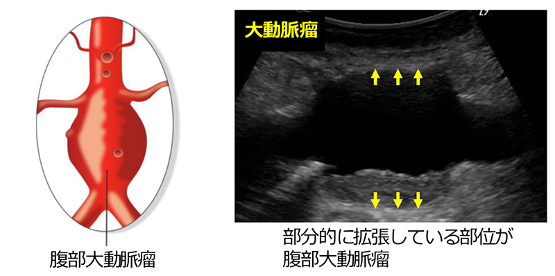腹部大動脈瘤のエコー画像