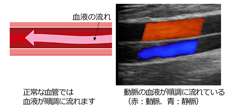 正常な下肢動脈の模式図とエコー画像