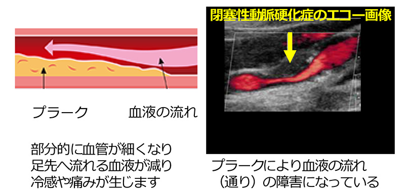 閉塞性動脈硬化症の模式図とエコー画像
