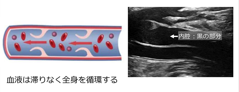 正常な下肢静脈の模式図とエコー画像