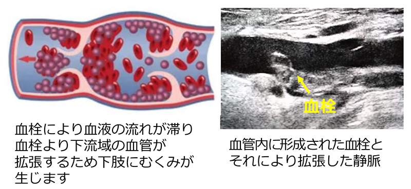 深部静脈血栓症の静脈の模式図とエコー画像