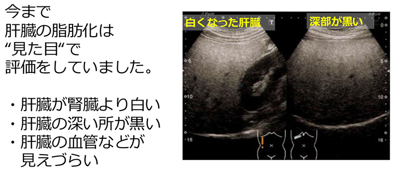 従来の肝脂肪化評価