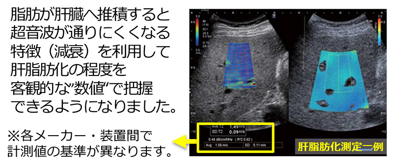 肝脂肪化測定