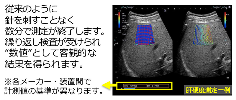 肝硬度測定