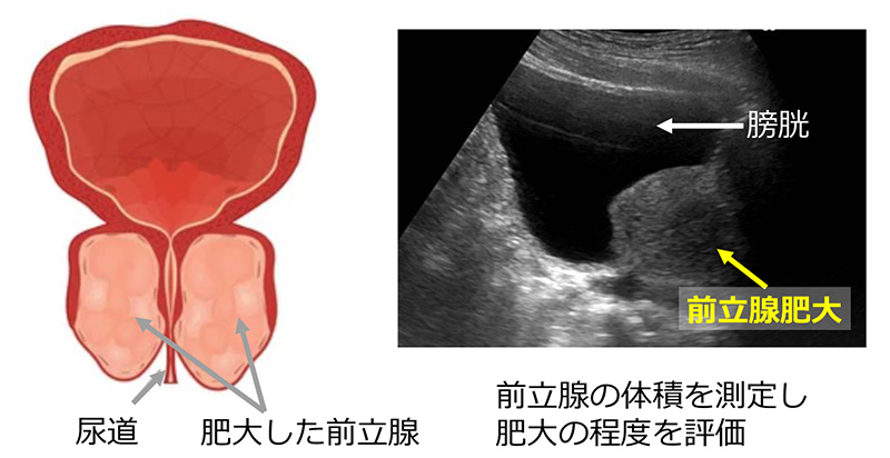 前立腺肥大症の模式図とエコー画像